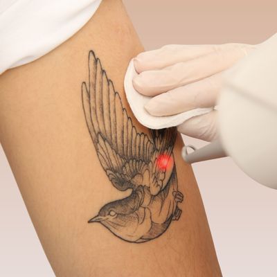 Laser Tattoo Removal Laser Tattoo Removal