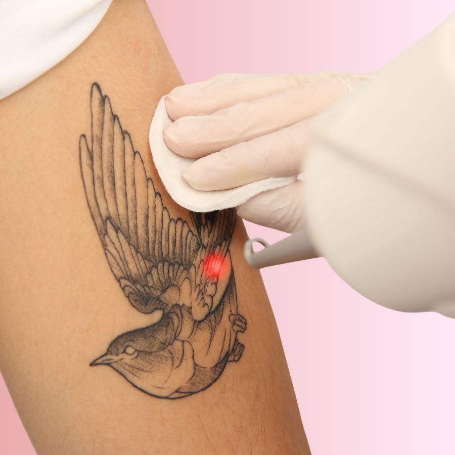 Laser Tattoo Removal