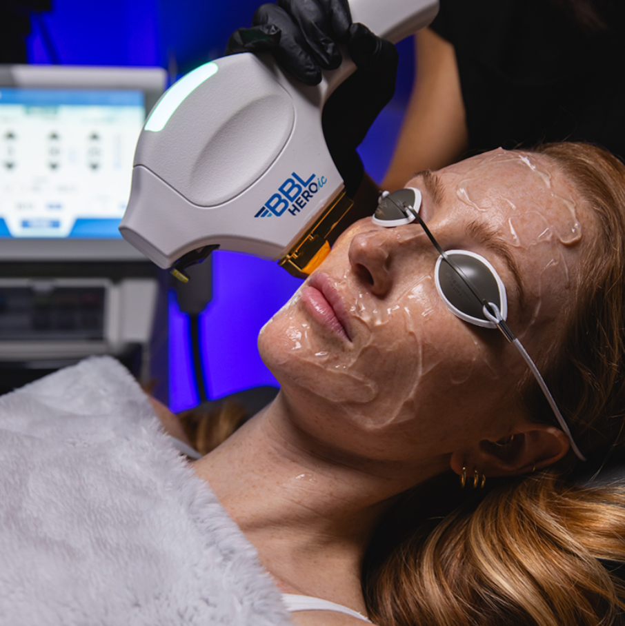 BBL Photofacial - Buy 3 Get 1 Free Package