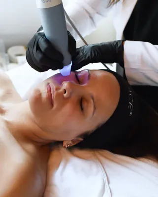 Exion RF Microneedling Face and Neck Exion RF Microneedling Face and Neck