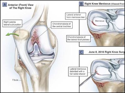 Personal Injury