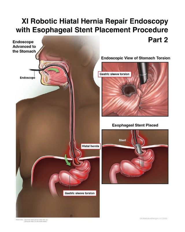 XI Robotic Hiatal Hernia Repair Endoscopy with Esophageal Stent Placement Procedure - Part 2