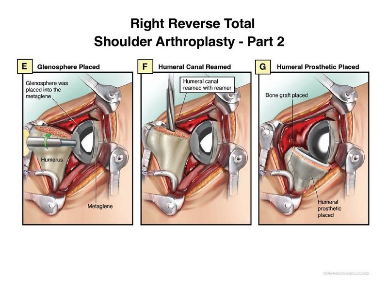 ​Right Total Reverse Shoulder Surgery Part 2