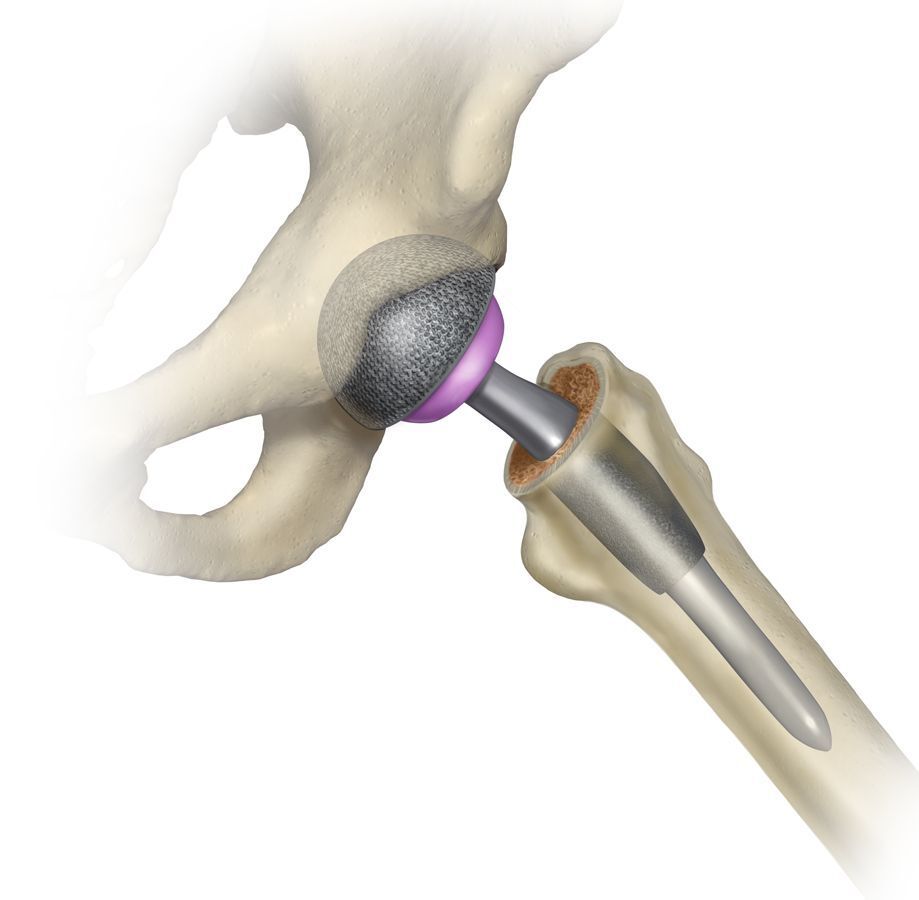 Total Hip Replacement