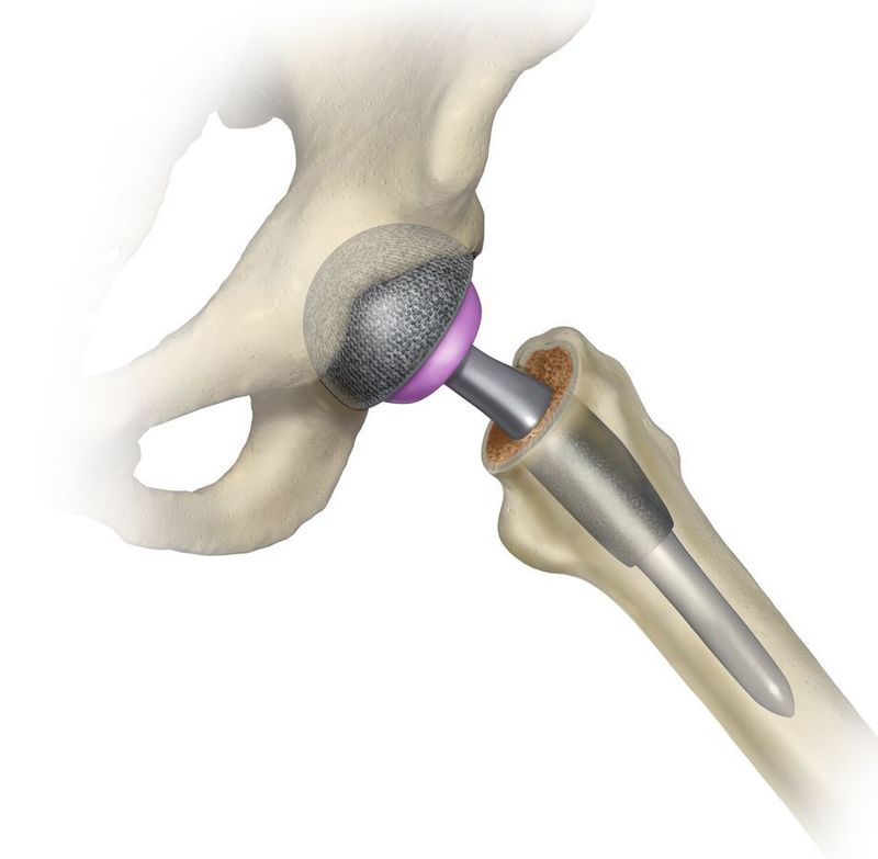 Total Hip Replacement