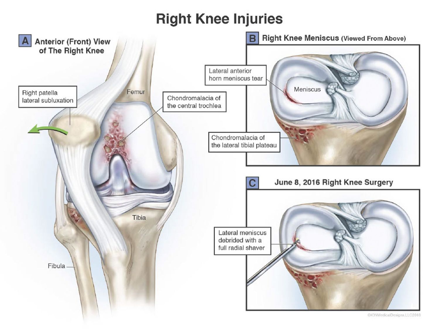 Right Knee Injuries
