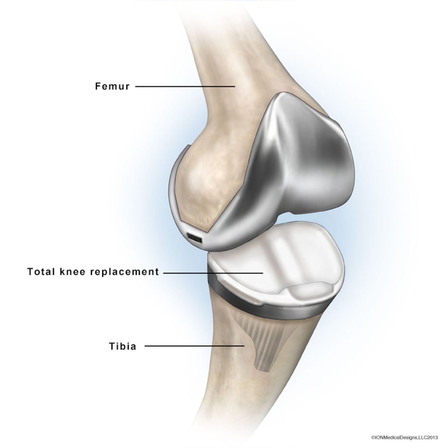 ​Total Knee Replacement