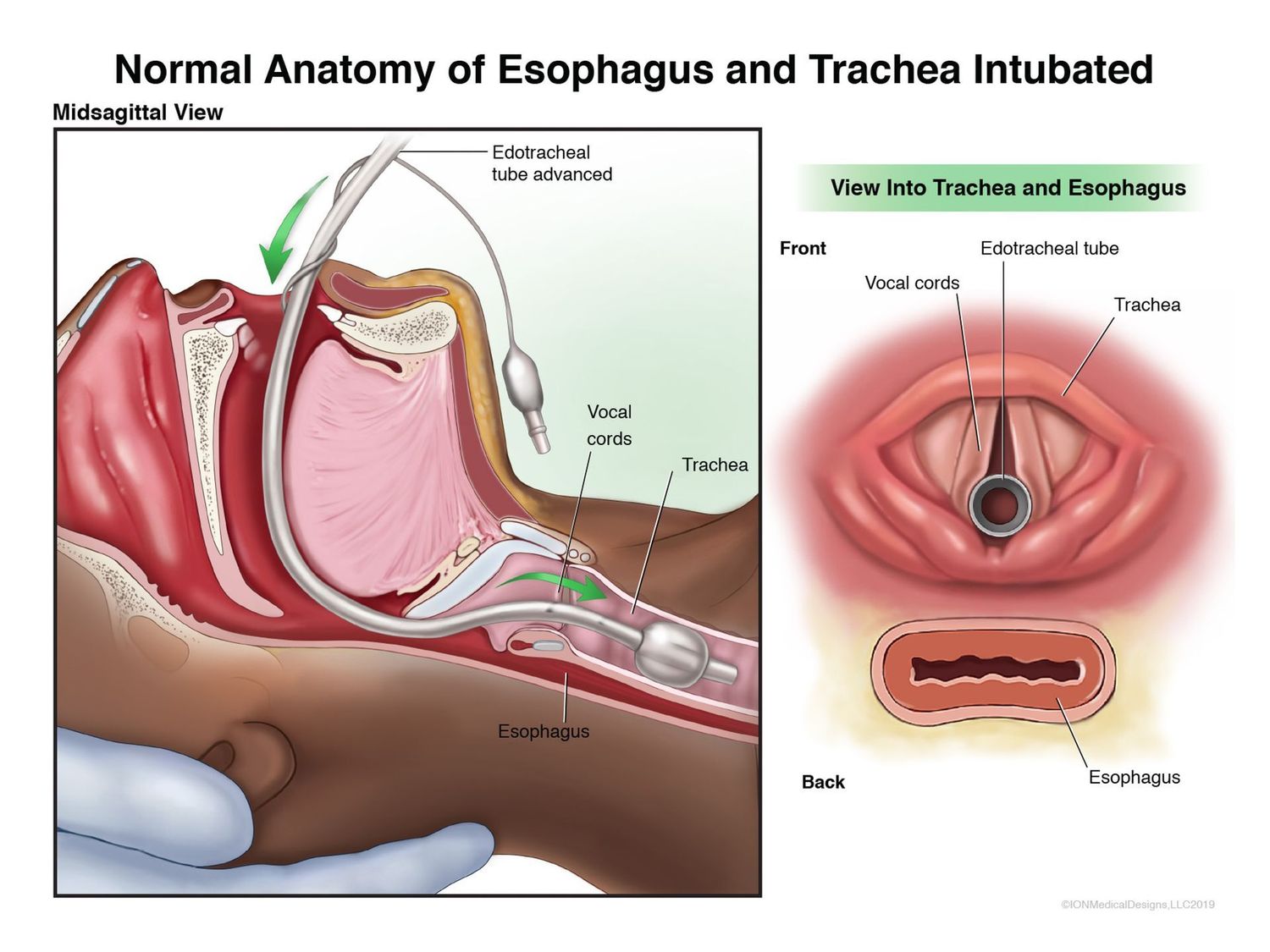 Normal Anatomy of Esophagus and Trachea Intubated