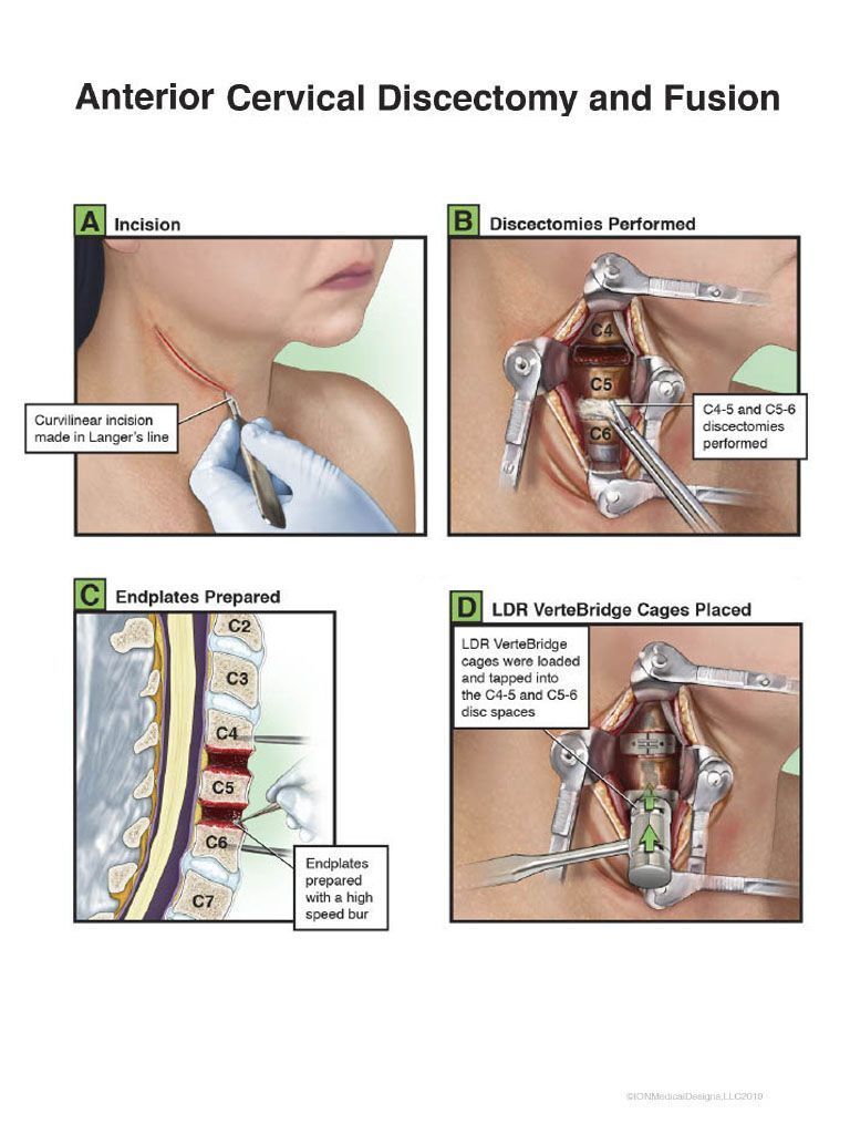 Anterior Cervical Discectomy and Fusion