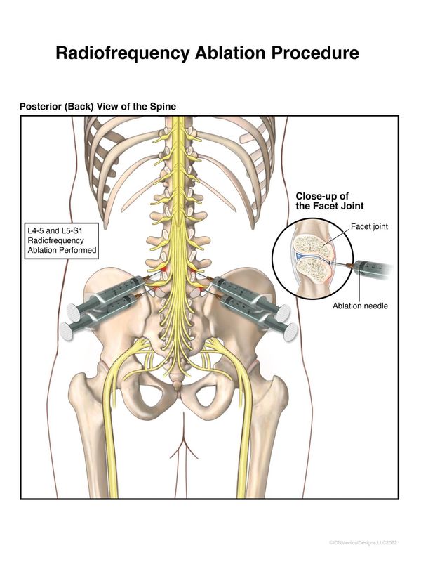 ​Radiofrequency Ablation Procedure