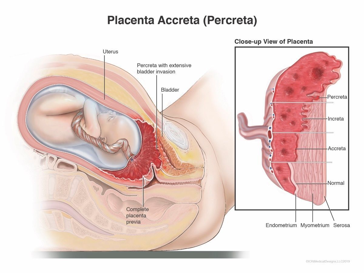 ​Placenta Accreta