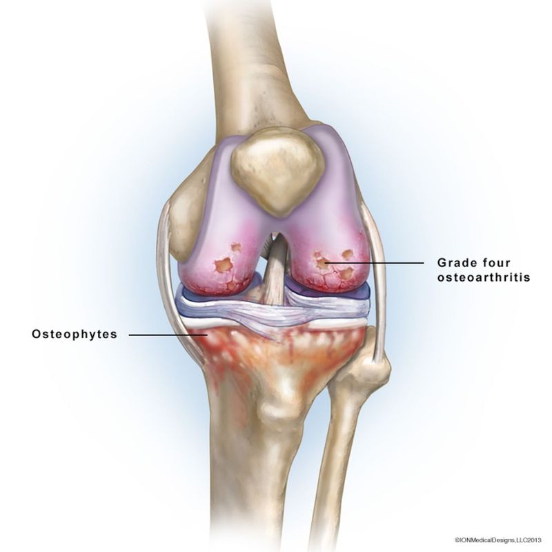 Arthritis of the left knee.