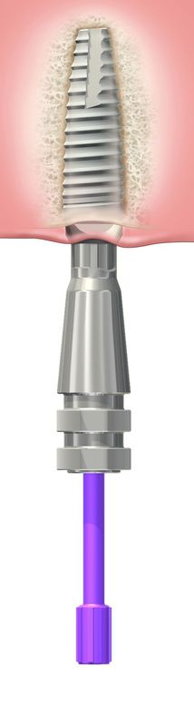Open Impression Coping - Dental Implant