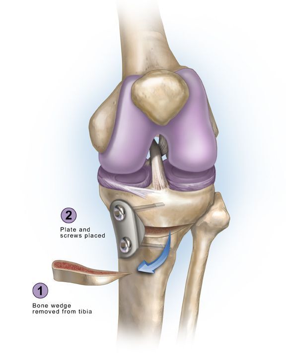 Osteotomy