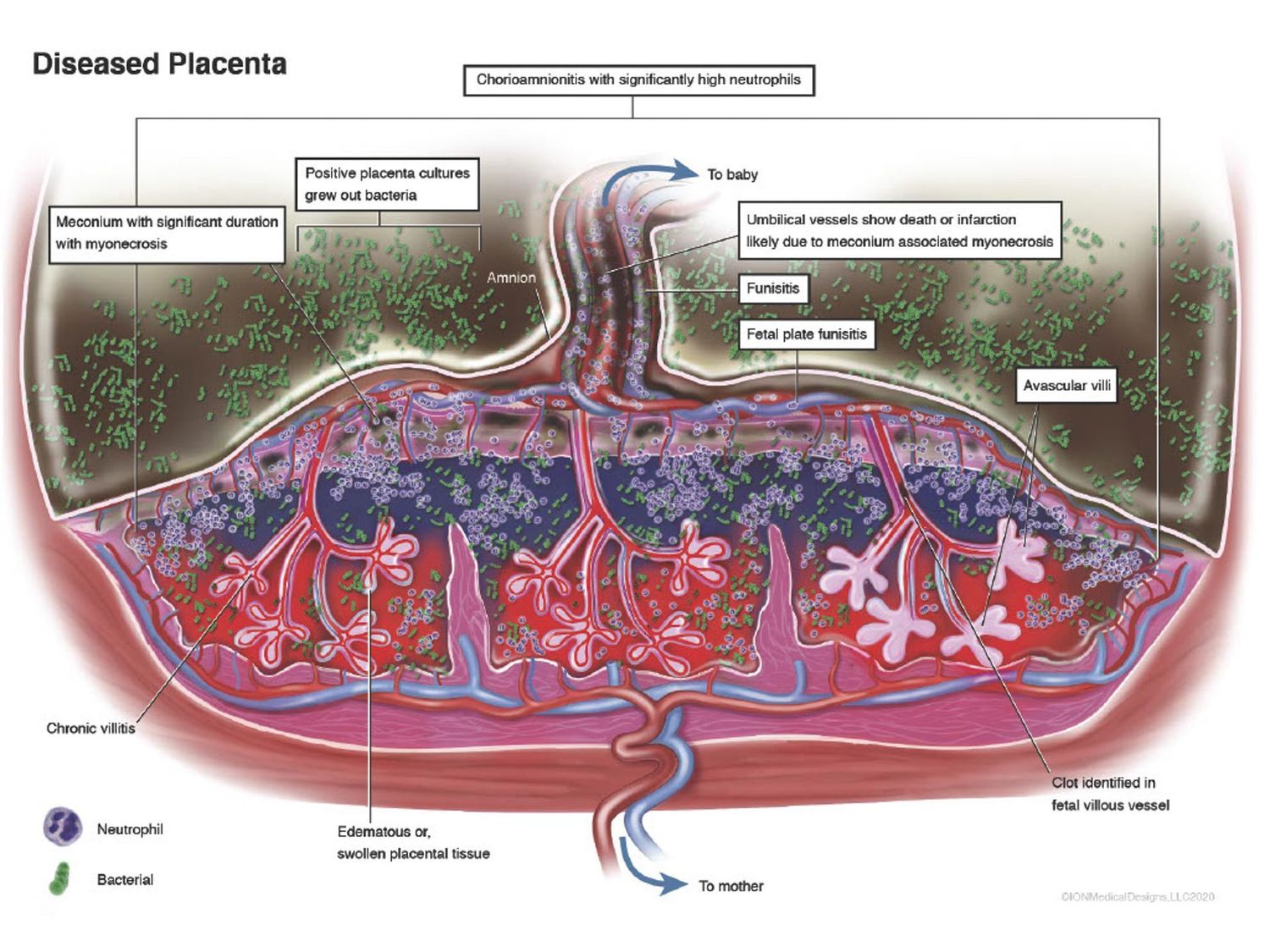 ​Diseased Placenta