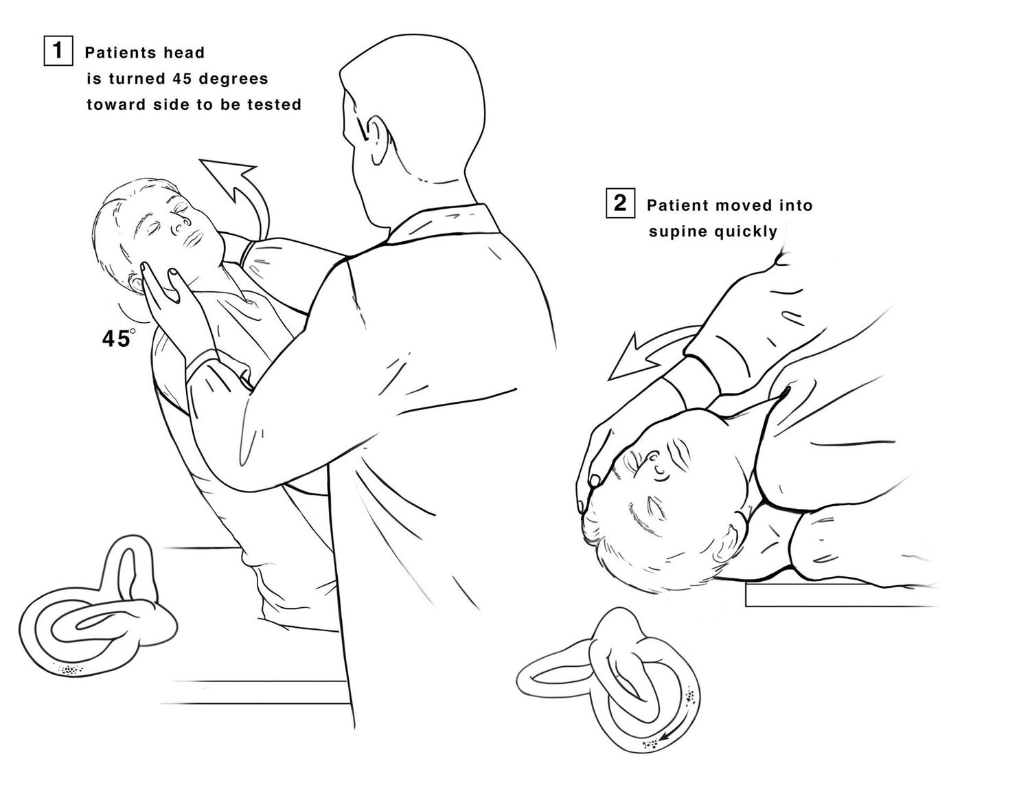 Epply Maneuver