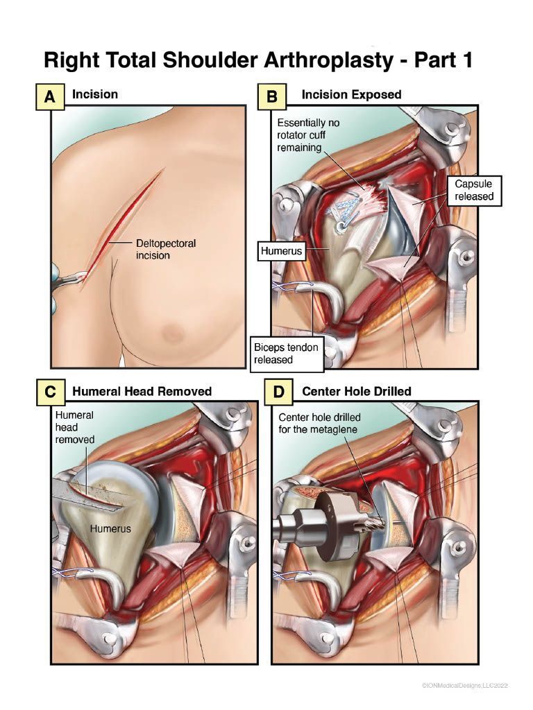 ​Right Total Reverse Shoulder Surgery Part 1