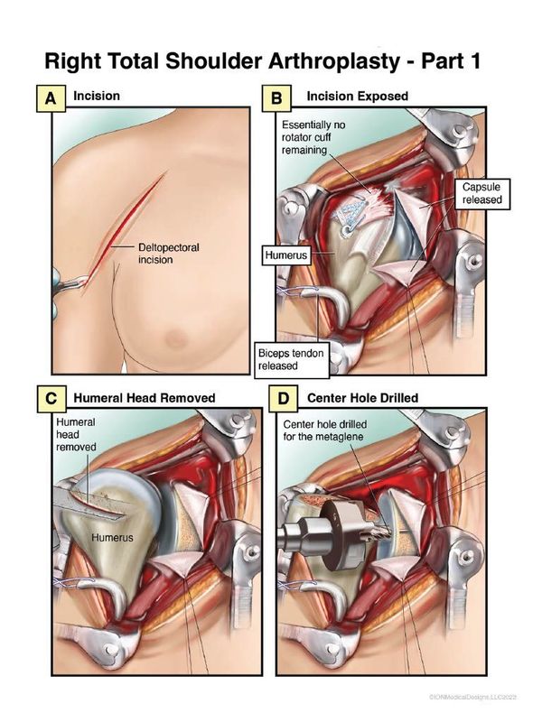​Right Total Reverse Shoulder Surgery Part 1