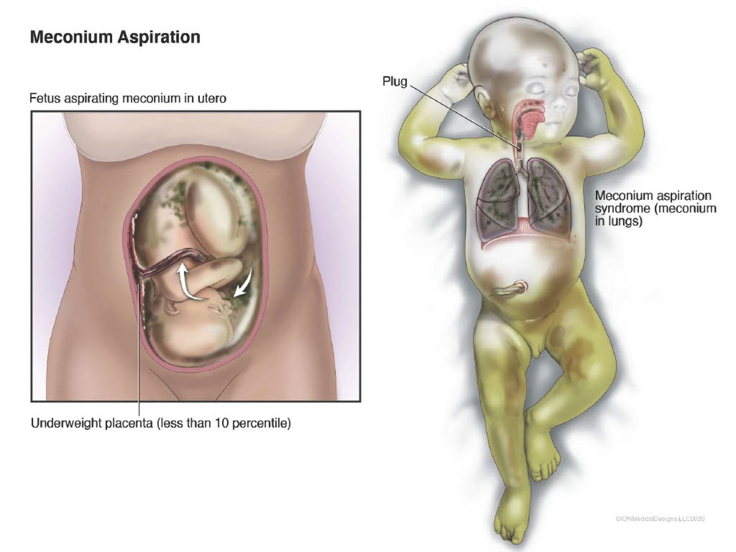 ​Meconium Aspiration