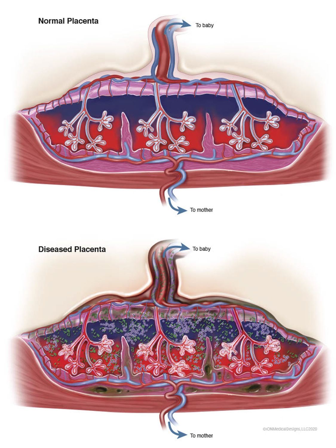 ​Normal and Diseased Placenta
