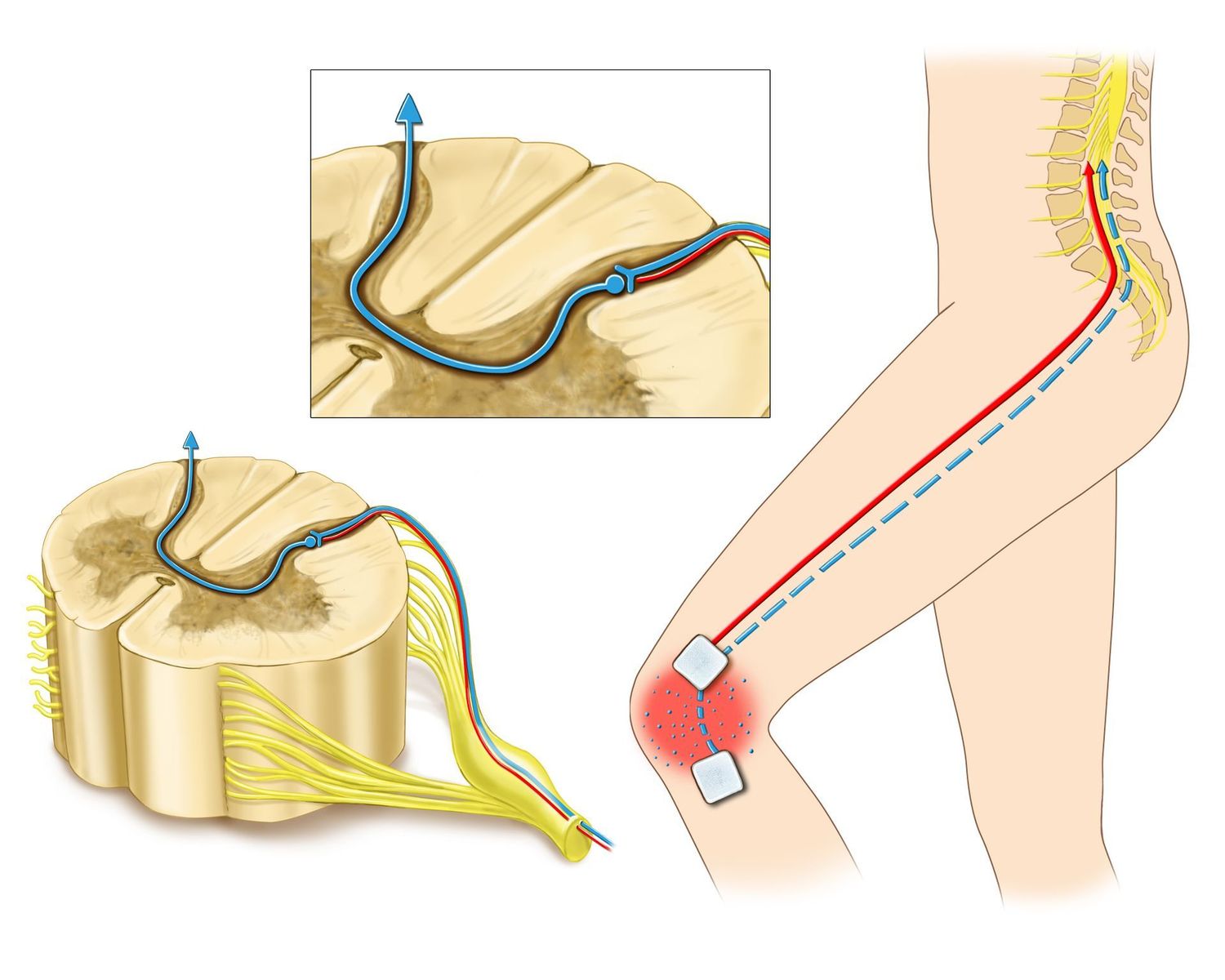 Tens Electrode Unit