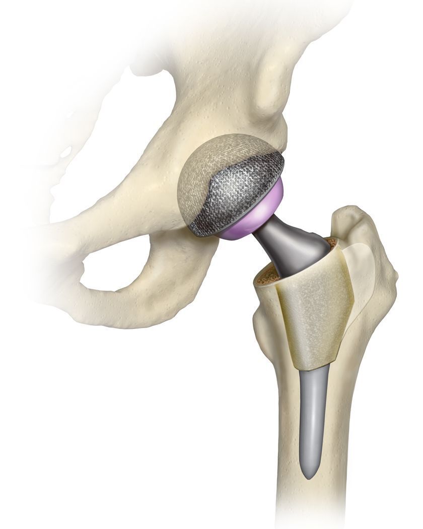 Total Hip Replacement