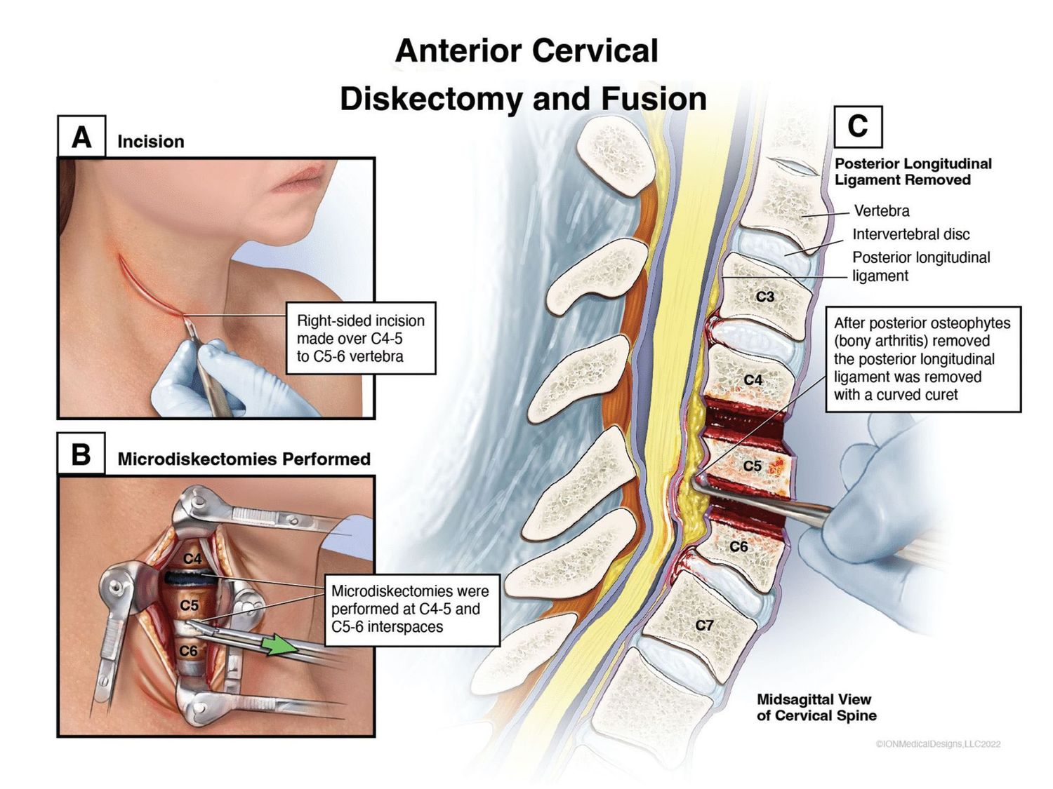 Anterior Cervical Diskectomy and Fusion