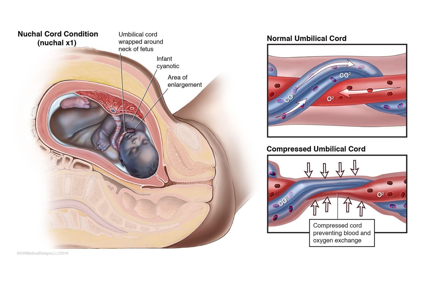 ​Nuchal Cord Condition