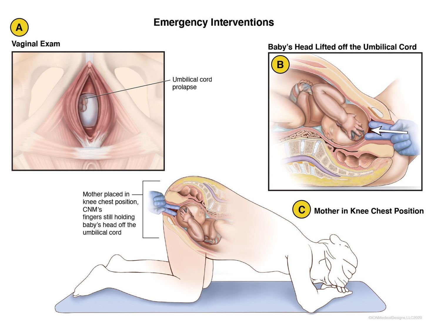 ​Emergency Birth Interventions