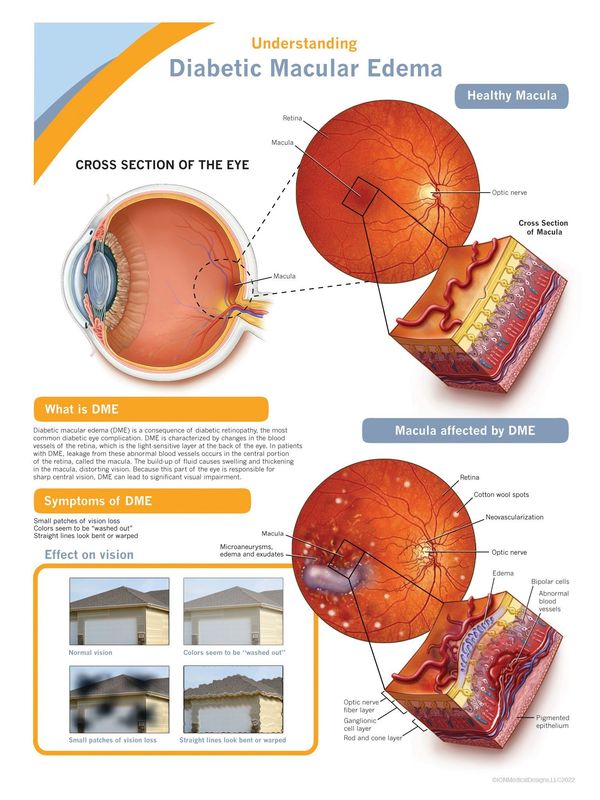 Diabetic Macular Edema