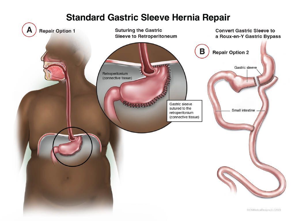 Standard Gastric Sleeve Hernia Repair