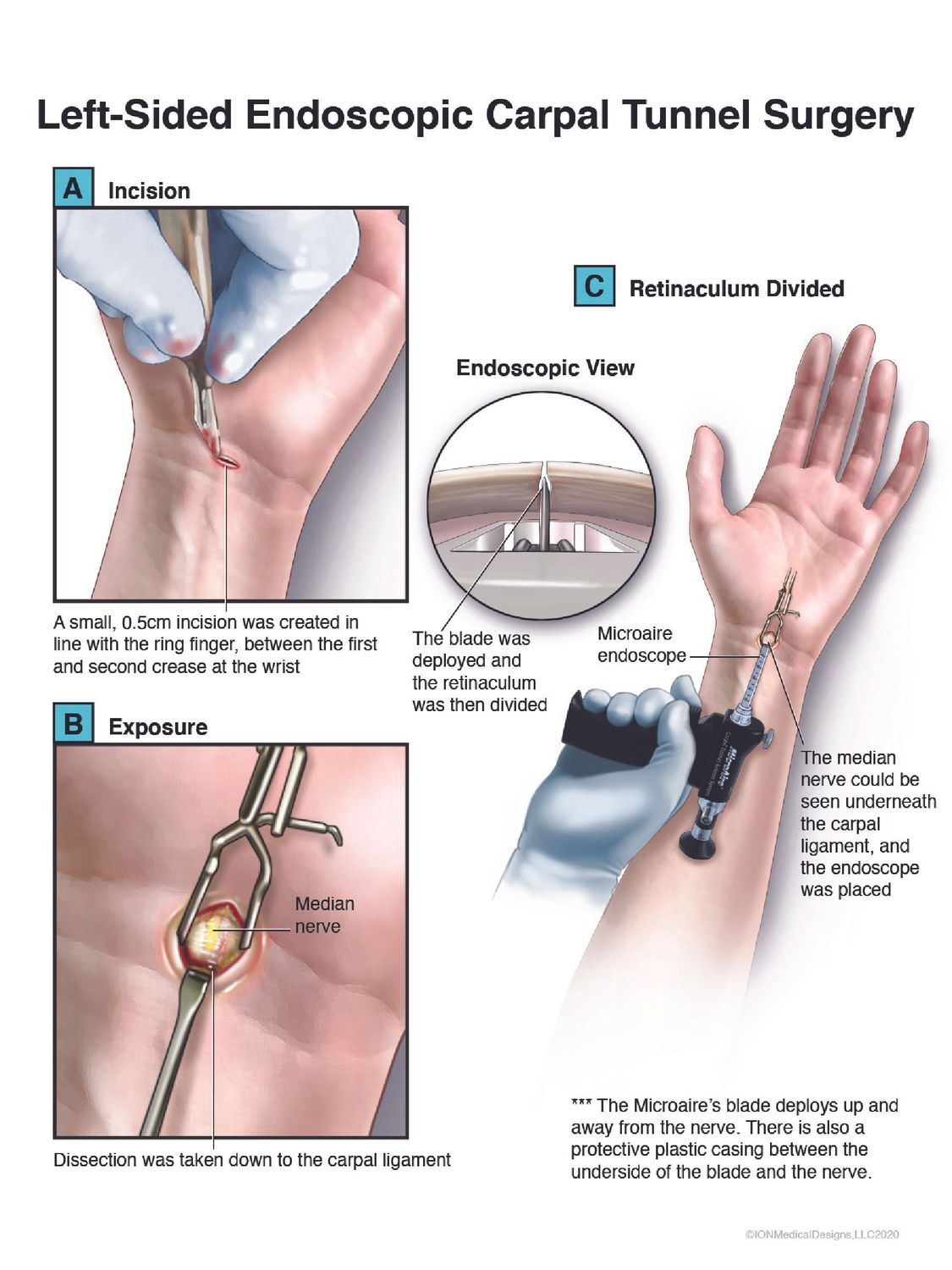 Left-Side Endoscopic Carpal Tunnel Surgery
