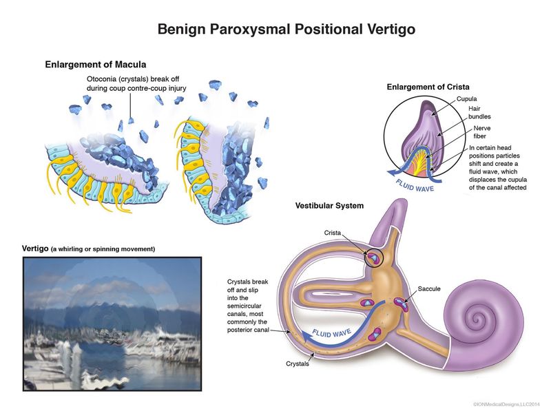 Benign Proxysmal Positional Vertigo