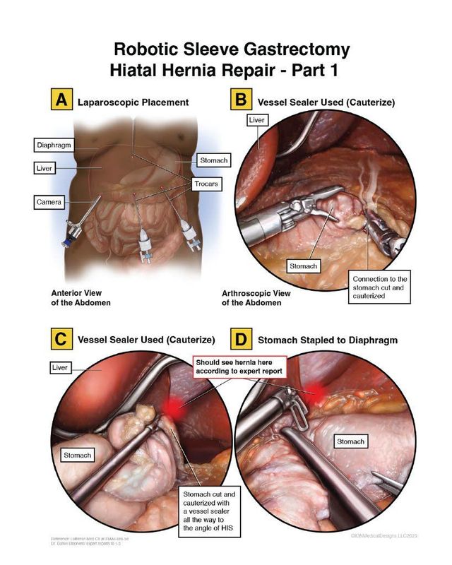Robotic Sleeve Gastrectomy Hiatal Hernia Repair - Part 1
