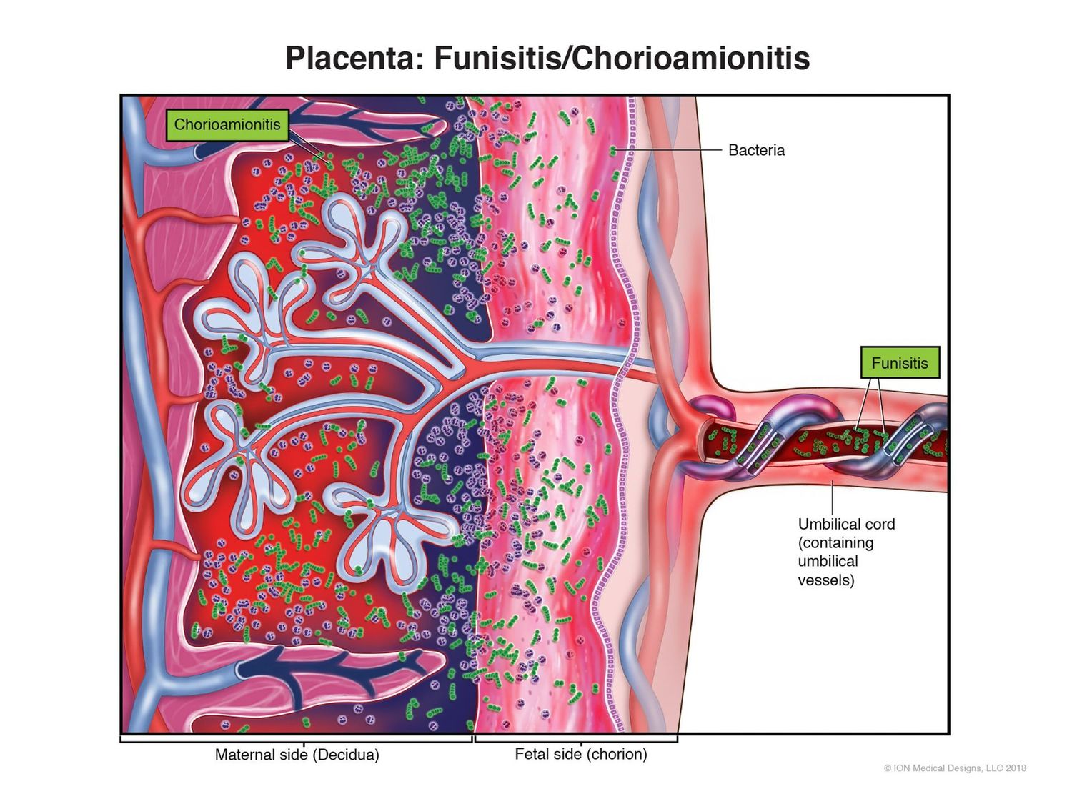 ​Placenta: Funisitis/Chorioamionitis