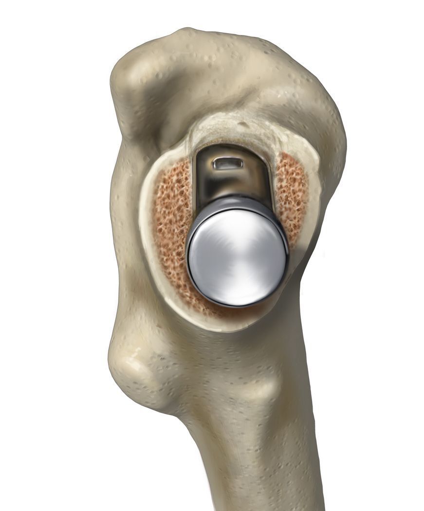 Total Hip Replacement - Revelation Short Stem
