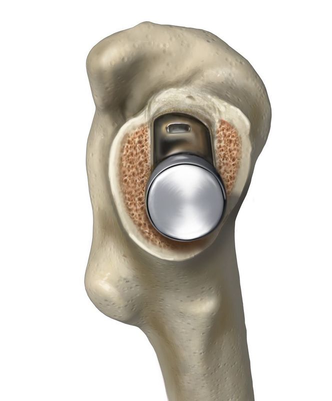 Total Hip Replacement - Revelation Short Stem