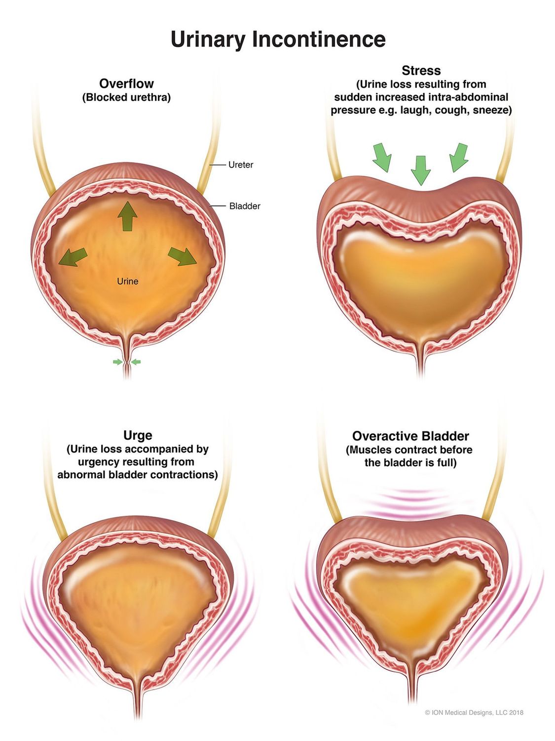 ​Urinary Incontinence