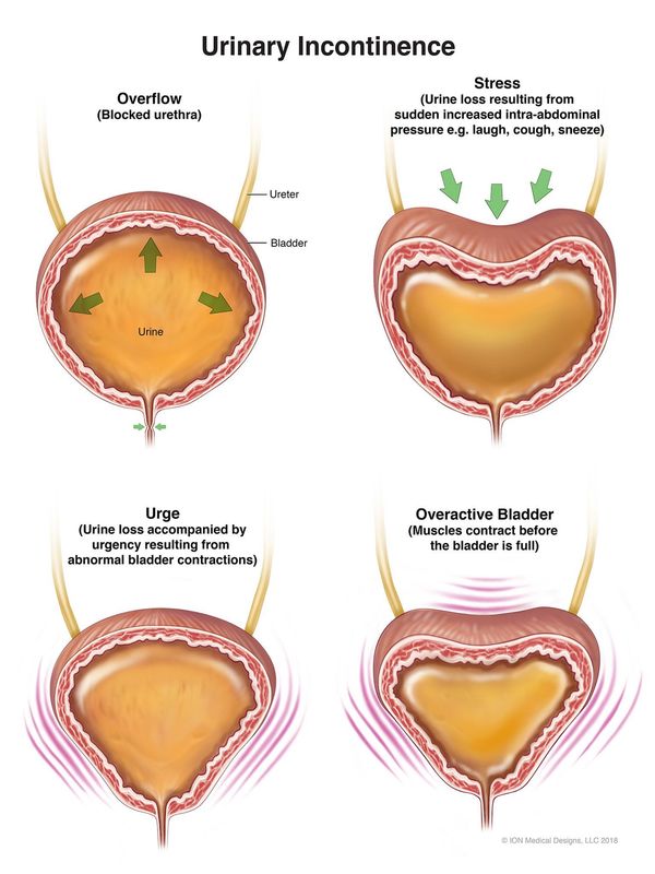 ​Urinary Incontinence