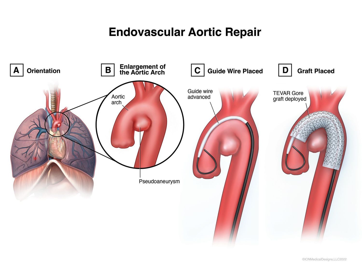 ​Endovascular Aortic Repair
