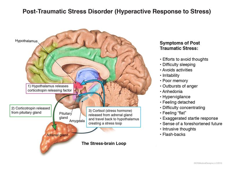 ​Post Traumatic Stress Disorder (Hyperactive Response to Stress)