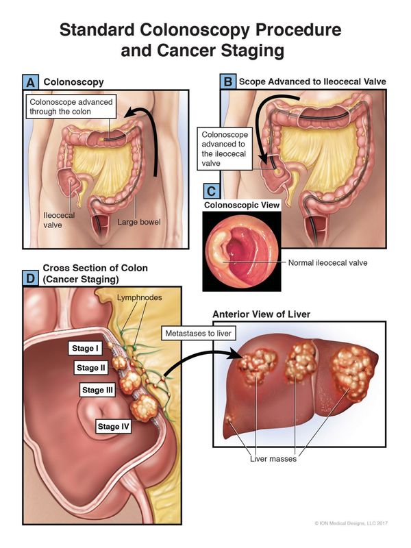 ​Standard Colonoscopy Procedure and Cancer Staging