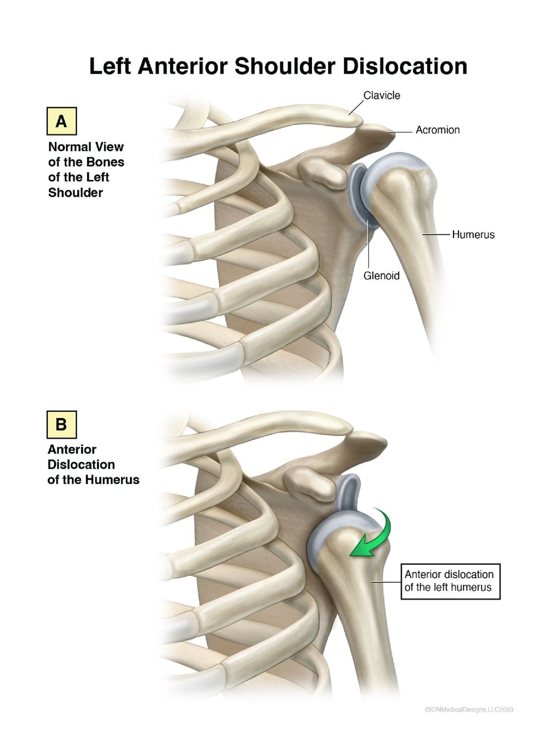 Left Anterior Shoulder Dislocation