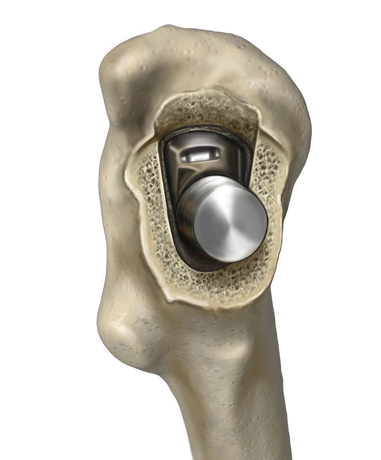 Hip Replacement Stem