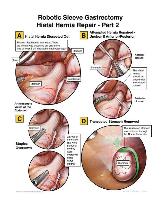 Robotic Sleeve Gastrectomy Hiatal Hernia Repair - Part 2