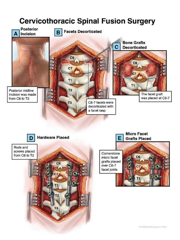 Cervicothoracic Spinal Fusion Surgery