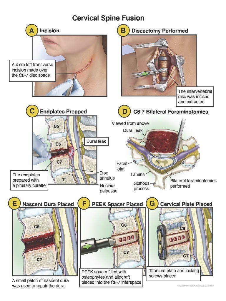 Cervical Spine Fusion