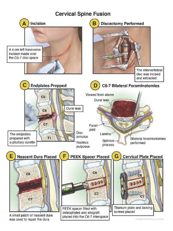 Cervical Spine Fusion