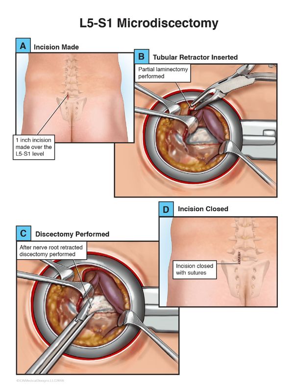 L5-S1 Microdiscectomy
