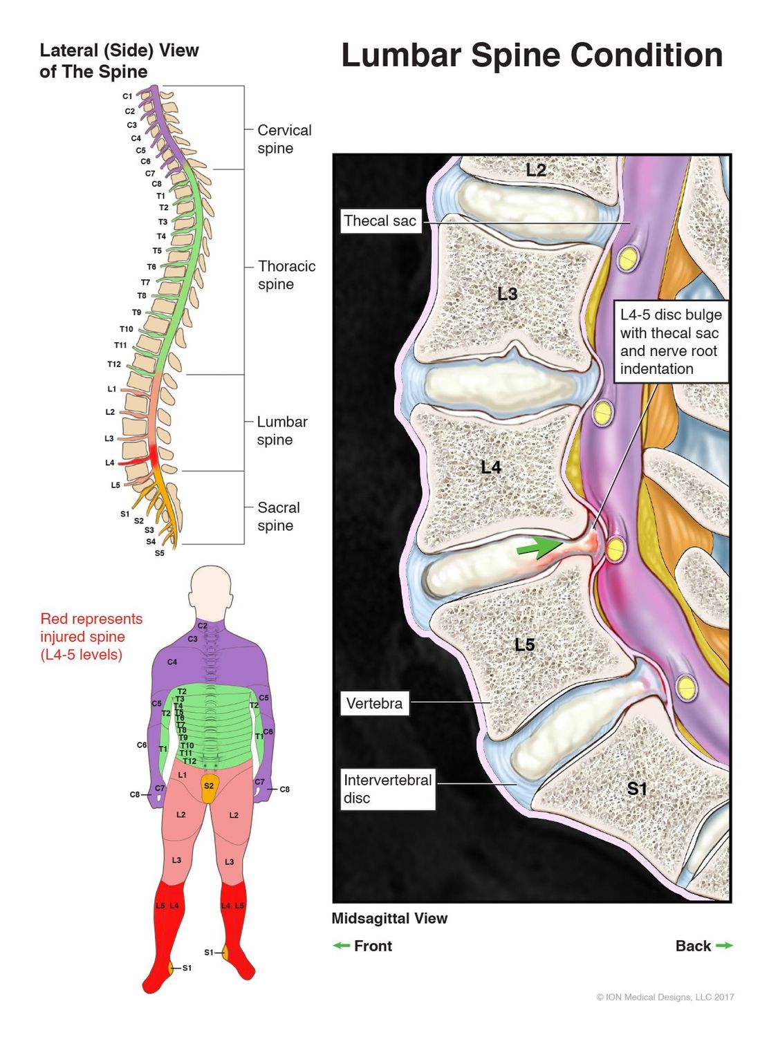 Lumbar Spine Condition